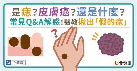 痣長毛|是痣？皮膚癌？還是什麼？常見Q&A解惑！醫教揪出「。